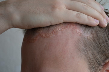 Fototapeta premium Psoriasis on the skin close-up, scalp, photos of dermatitis and eczema, skin problems, dermatology