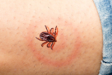 Irritation on skin for a tick bite