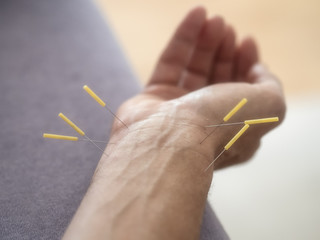 Acupuncture