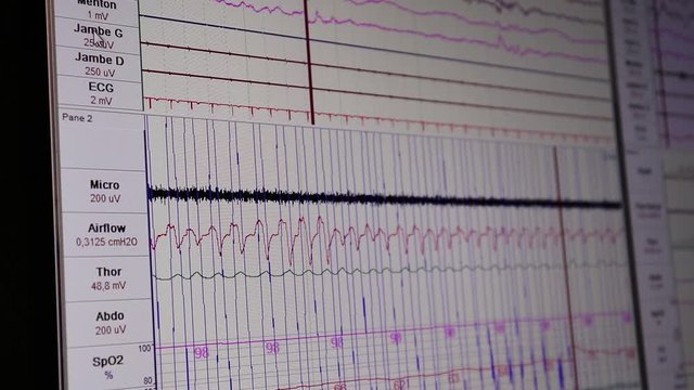 Monitor screen with moving lines of vital signs.