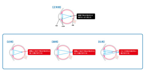 近視・遠視・乱視の図解ベクターイラスト