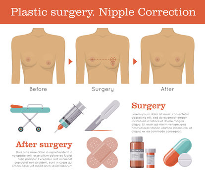 Nipple correction plastic surgery. Enlarged or inverted, asymmetrical, reconstruction procedure. Clinic poster. Female healthcare concept. Mockup vector illustration on white background