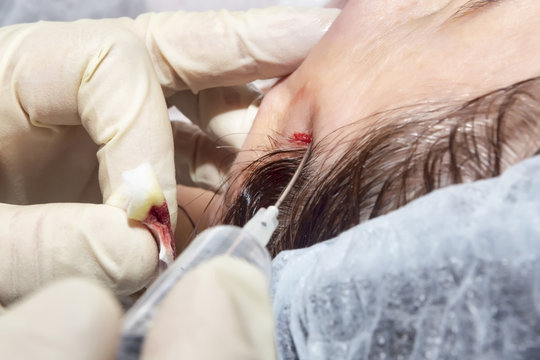 Local facial anesthesia: preparation for face lifting with poly lactic acid line - Selective focus