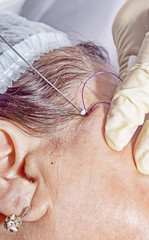 Dermatologist surgeon inserts polylactic acid filaments to perform facial lifting - Selective focus
