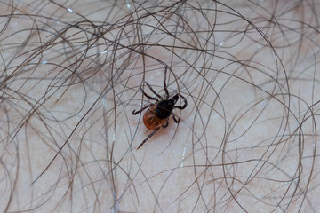 Mite encephalitis in hair
