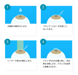 レーシック手術の図解ベクターイラスト