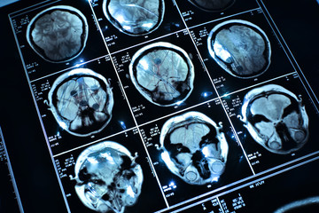 wire on brain medical x-ray