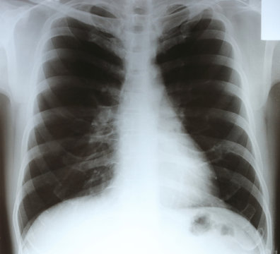 X-ray chest film , Check for lung cancer.