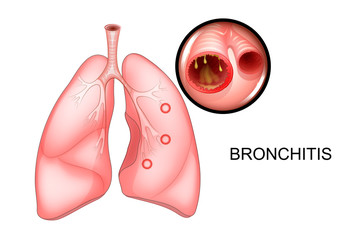 the lungs, affected with bronchitis - obrazy, fototapety, plakaty
