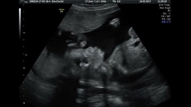 Ultrasound baby 22 weeks