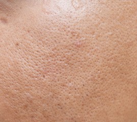 pores and oily on surface young asian man face skin do not take care for a long time