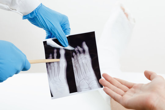 Doctor showing patient x-ray image of a broken finger leg in plaster