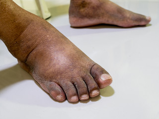 The feet of people with diabetes, dull and swollen. Due to the toxicity of diabetes.