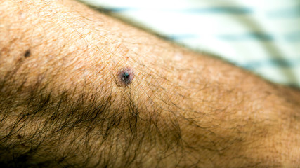 Small hematoma on the arm of an elderly man