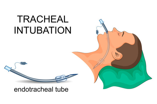 intubation of the trachea. artificial ventilation of the lungs