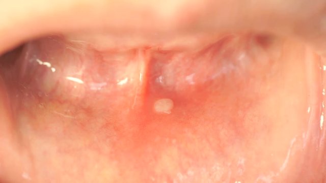 Disease in the mouth. Stomatitis into mouth on the lower lip. Close-up