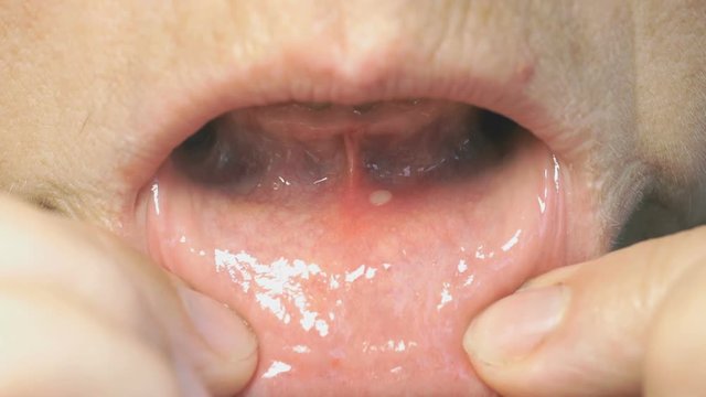 Close-up of stomatitis into mouth. Woman bends his lower lip and shows stomatitis