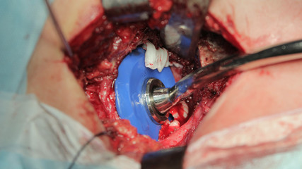 Orthopedic pusher use to push cement into the bottom of articular cavity