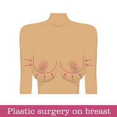 Plastic surgery breast reduction infographic. Scheme of surgical breast reduction. Correction of bust size in the form of a vector illustration