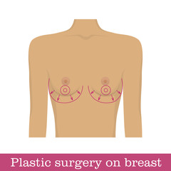 Plastic surgery breast augmentation infographic. Scheme of surgical breast augmentation. Correction of bust size in the form of a vector illustration