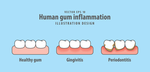Human gum inflammation illustration vector on blue background. Dental concept.