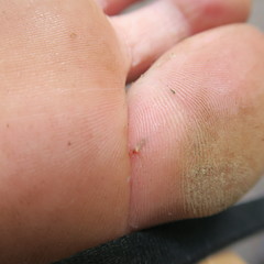 Close up of dirty feet with a splitter and cornea