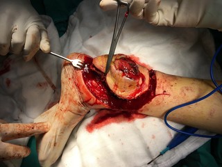 Tumor surgery of leg