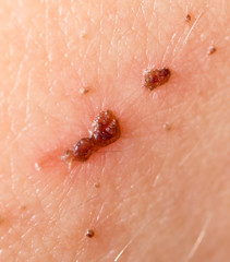 Wound on the skin of a person