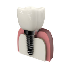 歯のインプラントと健康な歯茎