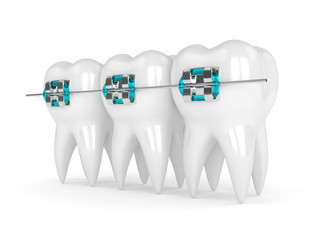 3d render of teeth with braces