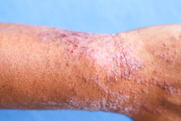 Dermatitis hypostasica