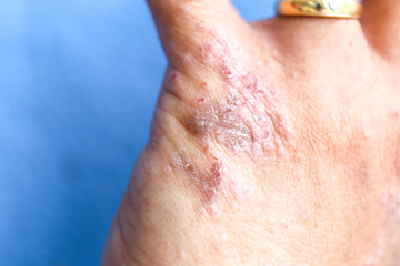 Atopic dermatitis (AD), also known as atopic eczema, is a type of inflammation of the skin (dermatitis).
