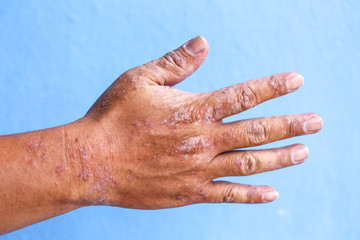 Atopic dermatitis (AD), also known as atopic eczema, is a type of inflammation of the skin...