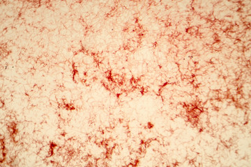 Actinomycetes, gram-positive anaerobic bacteria which resemble fungi, light micrograph. Actinomyces live in human gums and cause infections in dental procedures, oral abscesses and actinomycosis