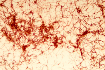 Actinomycetes, gram-positive anaerobic bacteria which resemble fungi, light micrograph. Actinomyces live in human gums and cause infections in dental procedures, oral abscesses and actinomycosis