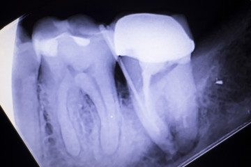Tooth crown root canal