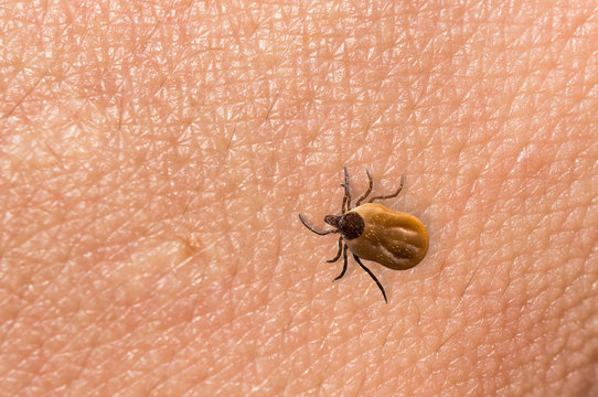 Tick filled with blood crawling on human body skin