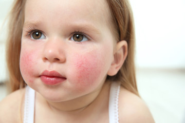 Portrait of little girl with diathesis symptoms on cheeks in light room