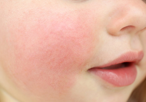 Little child with diathesis symptoms on cheeks, closeup