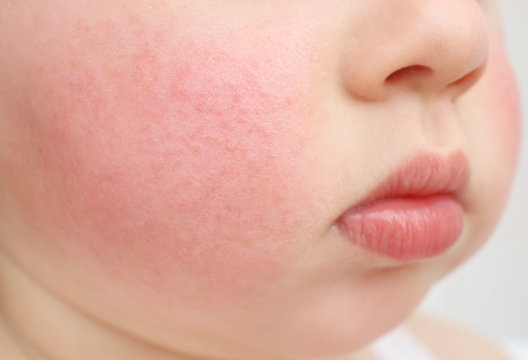 Little child with diathesis symptoms on cheeks, closeup