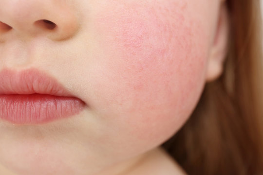 Little child with diathesis symptoms on cheeks, closeup