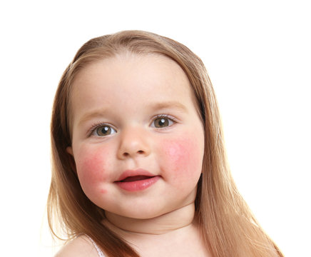 Portrait of little girl with diathesis symptoms on cheeks, against white background