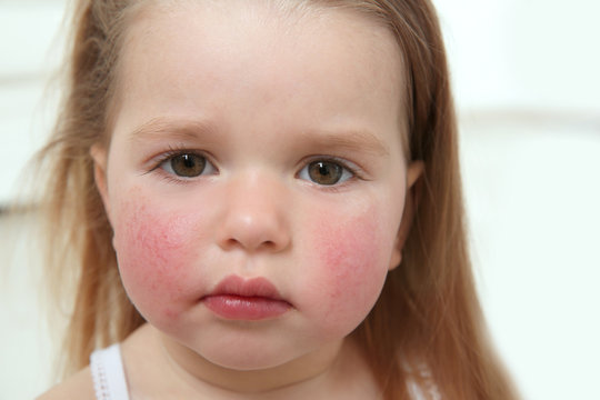 Portrait of little girl with diathesis symptoms on cheeks in light room