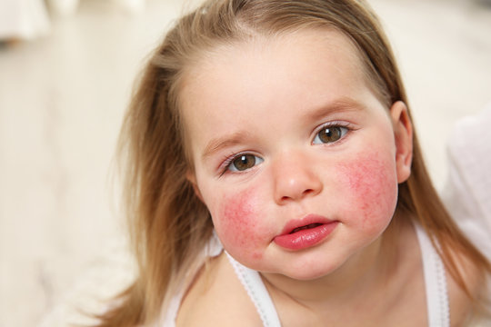 Portrait of little girl with diathesis symptoms on cheeks in light room