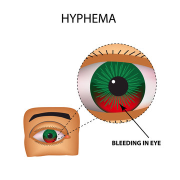 Hyphema. Anterior eye hemorrhage. The structure of the eye. Infographics. Vector illustration on isolated background