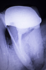 Tooth crown root canal