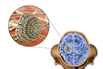 Aspergilloma of the brain and close-up view of fungi Aspergillus, 3D illustration. An intracranial lesion produced by fungi Aspergillus in immunocompromised patients