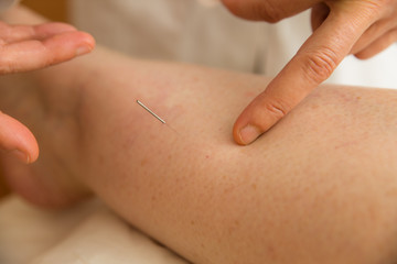 Obraz na płótnie Canvas Accupuncture needle being inserted into skin