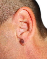 A man with a large mole on his ear. For medicine, the image of the nevus on the human ear, close-up. Skin of melanoma