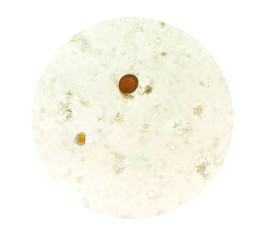 Stool parasites examination test for parasites or eggs in human stool sample with iodine stained...